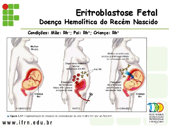 Eritroblastose Fetal Doença Hemolítica do Recém Nascido Condições: Mãe: Rh-; Pai: Rh+; Criança: Rh+