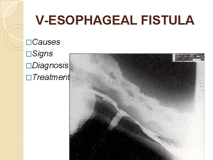 V-ESOPHAGEAL FISTULA �Causes �Signs �Diagnosis �Treatment 