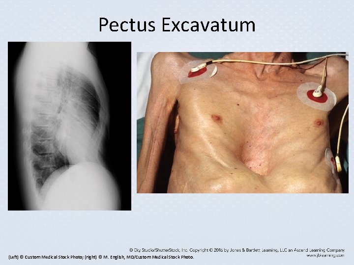 Pectus Excavatum (Left) © Custom Medical Stock Photo; (right) © M. English, MD/Custom Medical Pectus Excavatum (Left) © Custom Medical Stock Photo; (right) © M. English, MD/Custom Medical