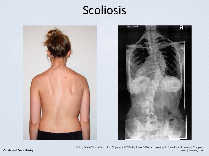 Scoliosis Courtesy of Darci Manley Scoliosis Courtesy of Darci Manley