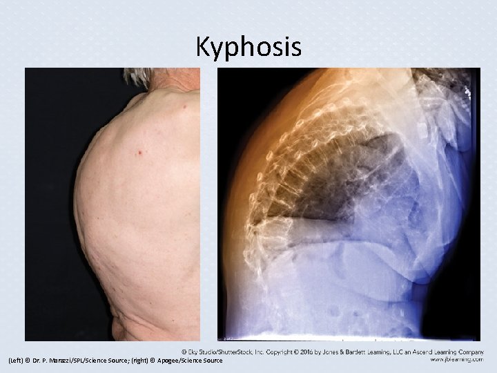Kyphosis (Left) © Dr. P. Marazzi/SPL/Science Source; (right) © Apogee/Science Source Kyphosis (Left) © Dr. P. Marazzi/SPL/Science Source; (right) © Apogee/Science Source