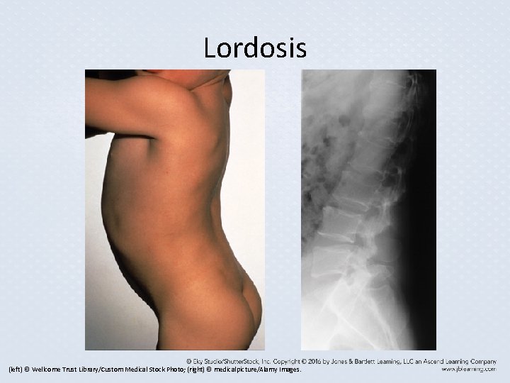 Lordosis (left) © Wellcome Trust Library/Custom Medical Stock Photo; (right) © medicalpicture/Alamy Images. Lordosis (left) © Wellcome Trust Library/Custom Medical Stock Photo; (right) © medicalpicture/Alamy Images.