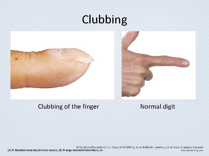 Clubbing of the finger (A) © Biophoto Associates/Science Source; (B) © Jorge Salcedo/Shutter. Stock, Clubbing of the finger (A) © Biophoto Associates/Science Source; (B) © Jorge Salcedo/Shutter. Stock,