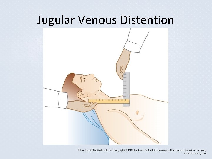 Jugular Venous Distention Jugular Venous Distention