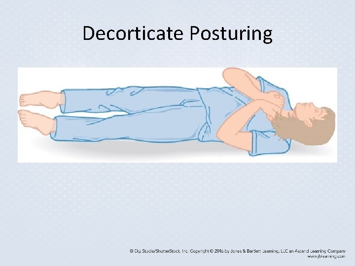 Decorticate Posturing Decorticate Posturing