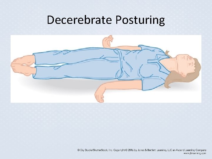 Decerebrate Posturing Decerebrate Posturing