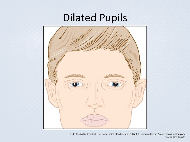 Dilated Pupils Dilated Pupils