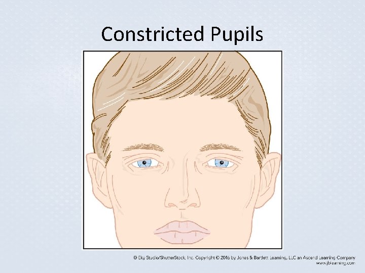 Constricted Pupils Constricted Pupils
