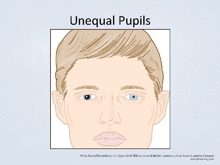 Unequal Pupils Unequal Pupils