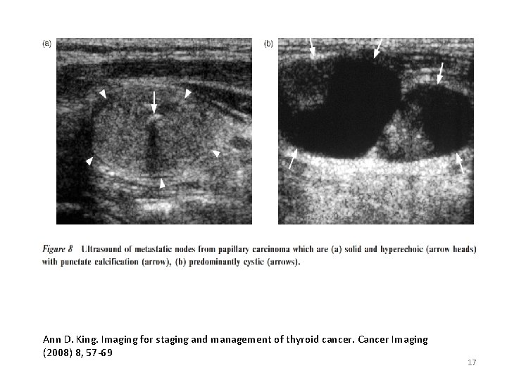 Ann D. King. Imaging for staging and management of thyroid cancer. Cancer Imaging (2008)