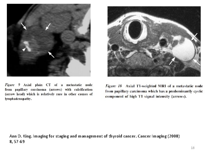 Ann D. King. Imaging for staging and management of thyroid cancer. Cancer Imaging (2008)