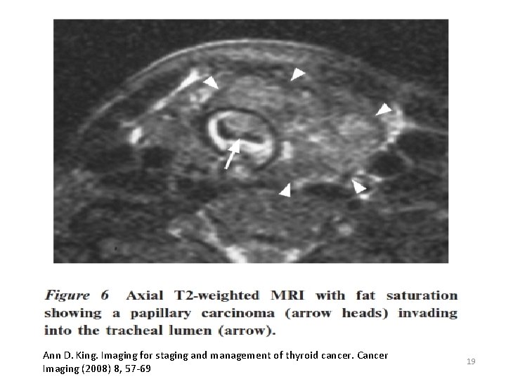 Ann D. King. Imaging for staging and management of thyroid cancer. Cancer Imaging (2008)