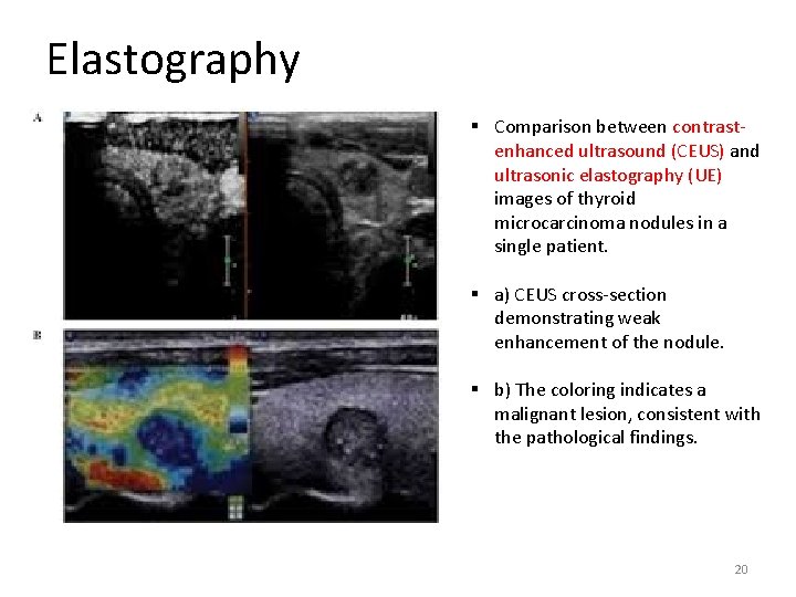 Elastography § Comparison between contrastenhanced ultrasound (CEUS) and ultrasonic elastography (UE) images of thyroid