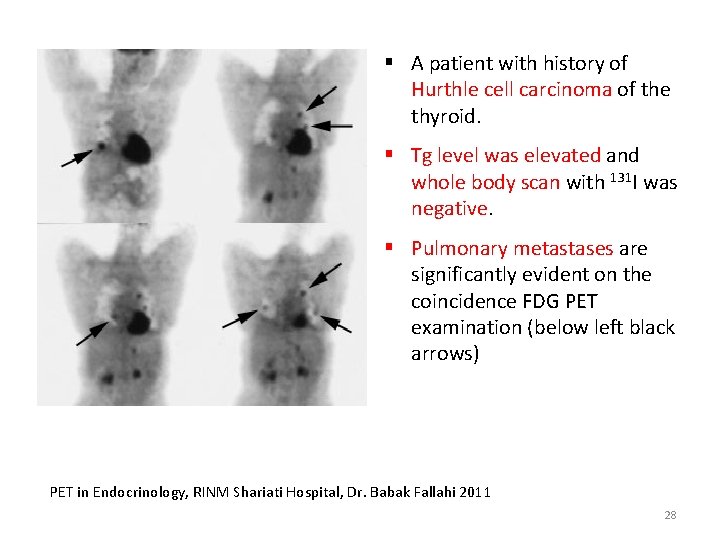§ A patient with history of Hurthle cell carcinoma of the thyroid. § Tg