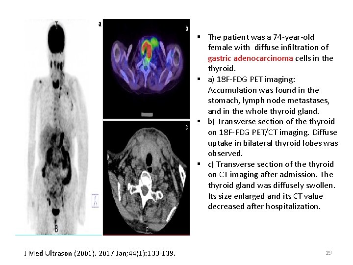 § The patient was a 74 -year-old female with diffuse inﬁltration of gastric adenocarcinoma