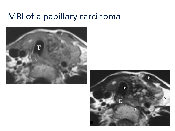 MRI of a papillary carcinoma 
