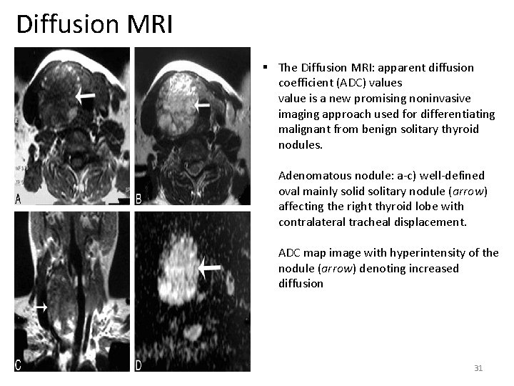 Diffusion MRI § The Diffusion MRI: apparent diffusion coefficient (ADC) values value is a