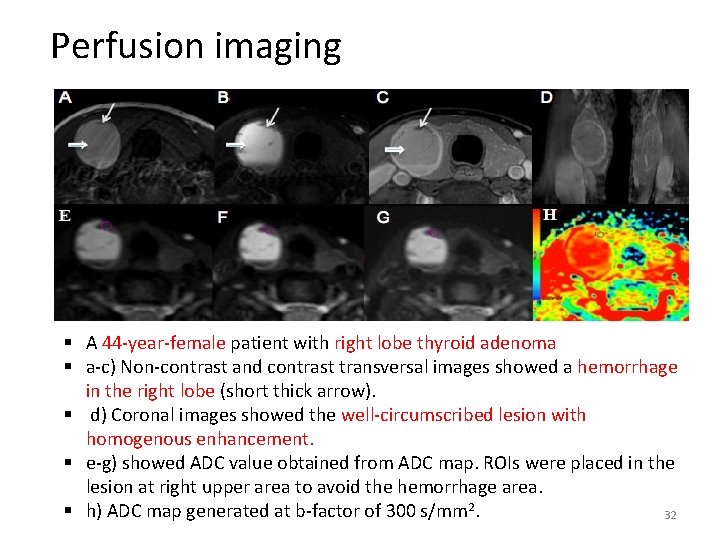 Perfusion imaging § A 44 -year-female patient with right lobe thyroid adenoma § a-c)