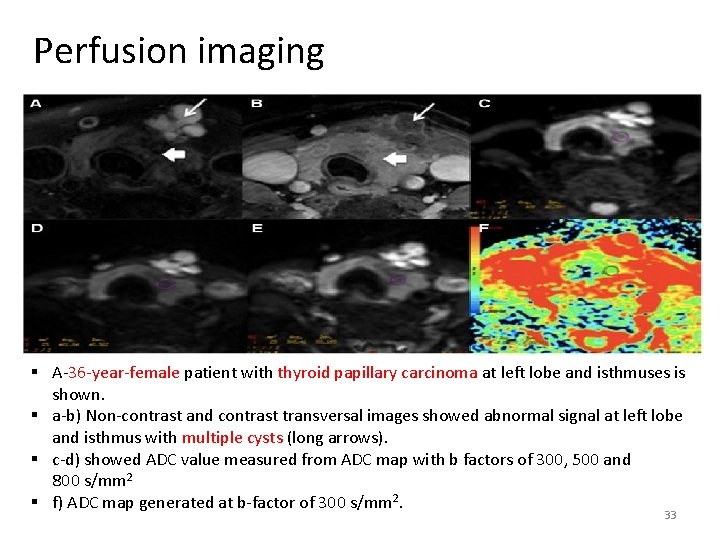 Perfusion imaging § A-36 -year-female patient with thyroid papillary carcinoma at left lobe and