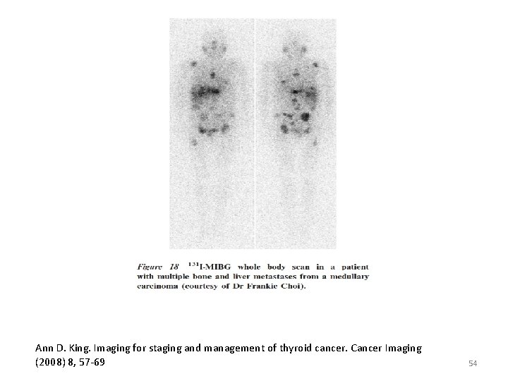 Ann D. King. Imaging for staging and management of thyroid cancer. Cancer Imaging (2008)