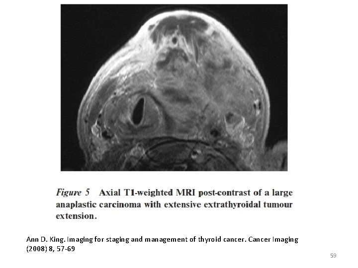 Ann D. King. Imaging for staging and management of thyroid cancer. Cancer Imaging (2008)