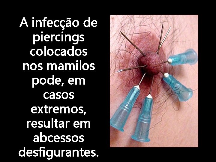 A infecção de piercings colocados nos mamilos pode, em casos extremos, resultar em abcessos