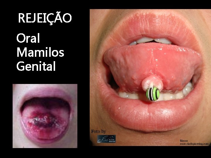 REJEIÇÃO Oral Mamilos Genital 