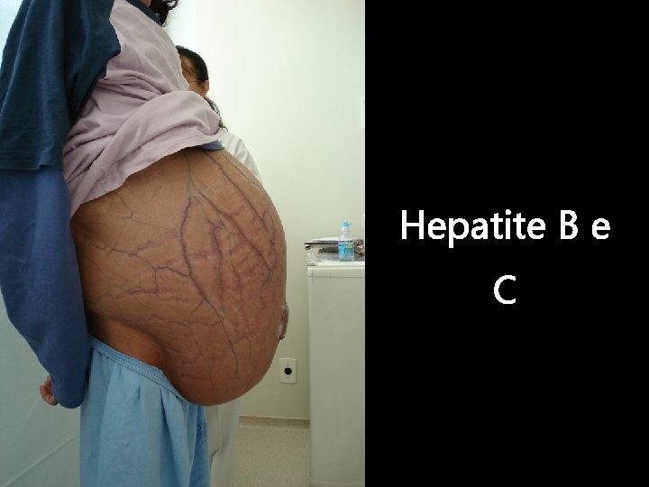 Hepatite B e C 