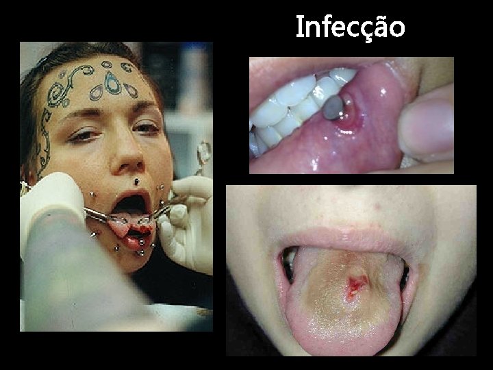 Infecção 