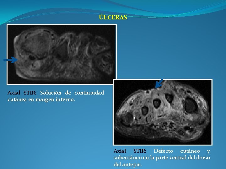 ÚLCERAS Axial STIR: Solución de continuidad cutánea en margen interno. Axial STIR: Defecto cutáneo