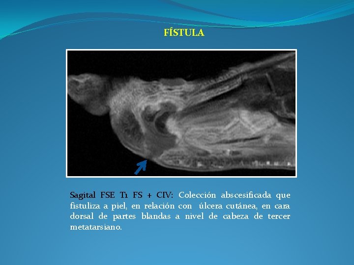 FÍSTULA Sagital FSE T 1 FS + CIV: Colección abscesificada que fistuliza a piel,