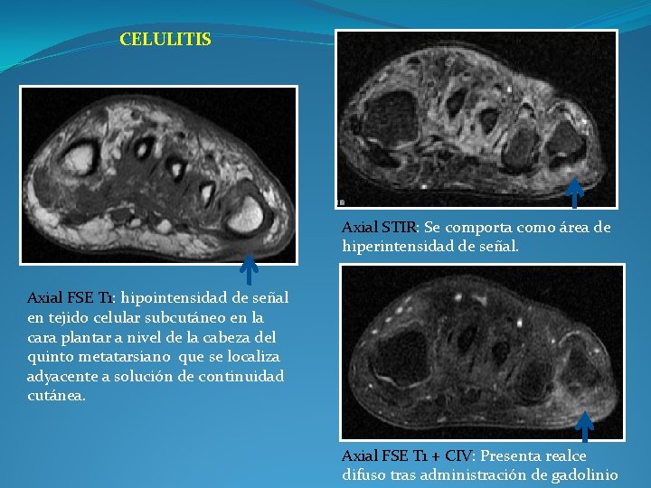 CELULITIS Axial STIR: Se comporta como área de hiperintensidad de señal. Axial FSE T