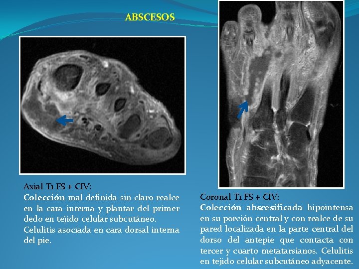 ABSCESOS Axial T 1 FS + CIV: Colección mal definida sin claro realce en