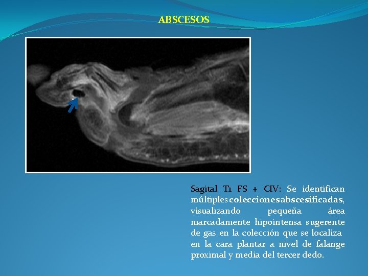 ABSCESOS Sagital T 1 FS + CIV: Se identifican múltiples colecciones abscesificadas, visualizando pequeña