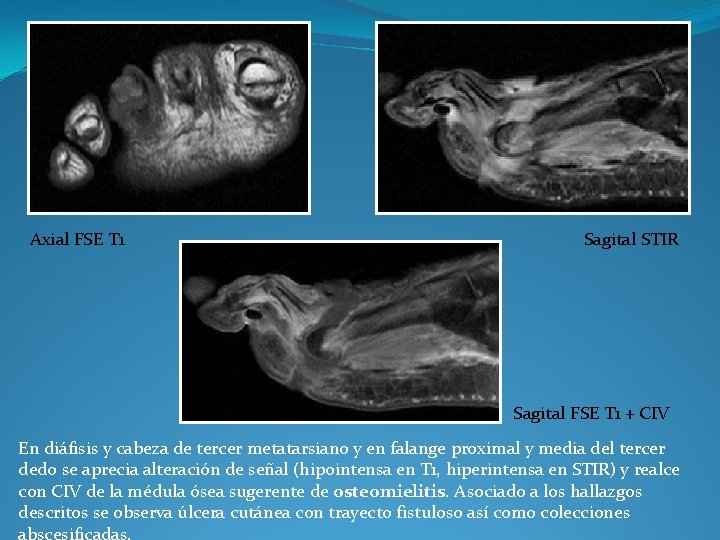 Axial FSE T 1 Sagital STIR Sagital FSE T 1 + CIV En diáfisis