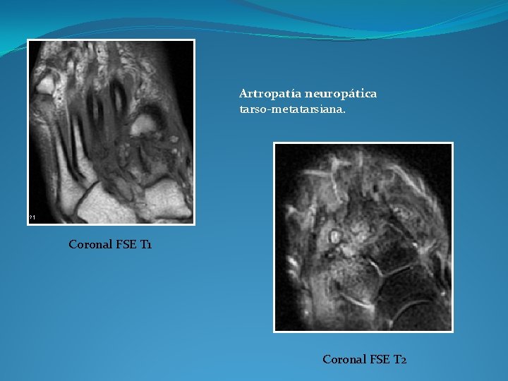 Artropatía neuropática tarso-metatarsiana. Coronal FSE T 1 Coronal FSE T 2 