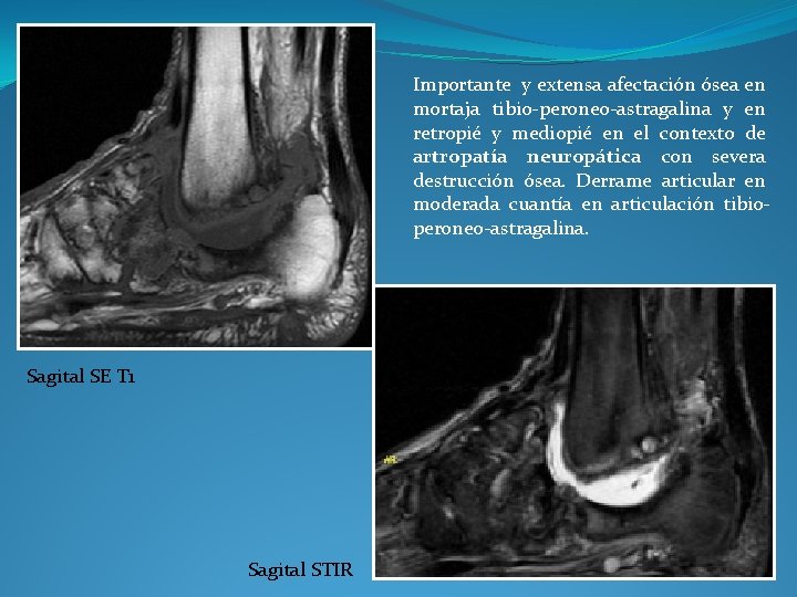 Importante y extensa afectación ósea en mortaja tibio-peroneo-astragalina y en retropié y mediopié en