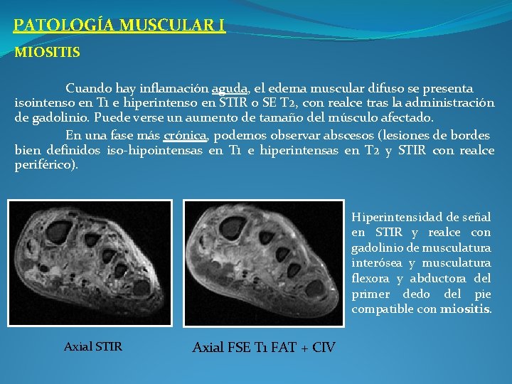 PATOLOGÍA MUSCULAR I MIOSITIS Cuando hay inflamación aguda, el edema muscular difuso se presenta