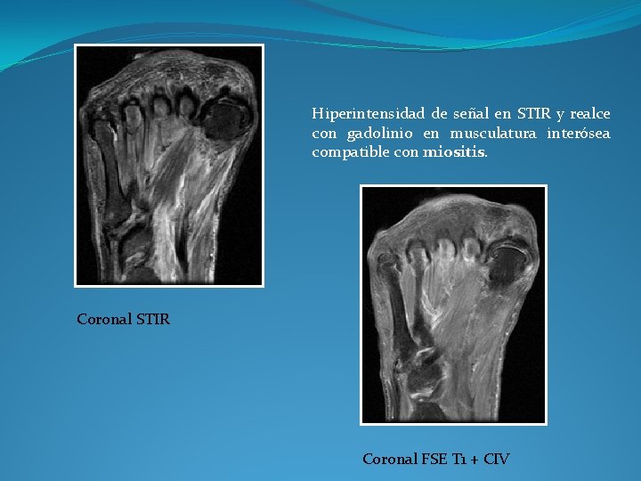 Hiperintensidad de señal en STIR y realce con gadolinio en musculatura interósea compatible con