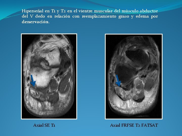 Hiperseñal en T 1 y T 2 en el vientre muscular del músculo abductor