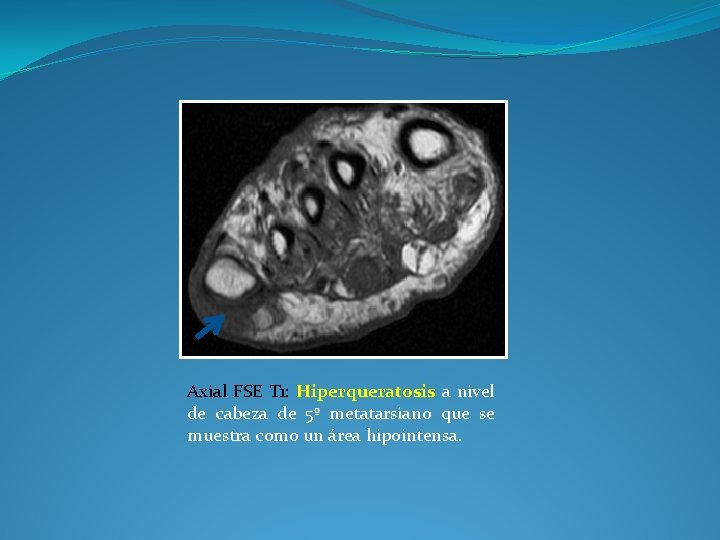 Axial FSE T 1: Hiperqueratosis a nivel de cabeza de 5º metatarsiano que se