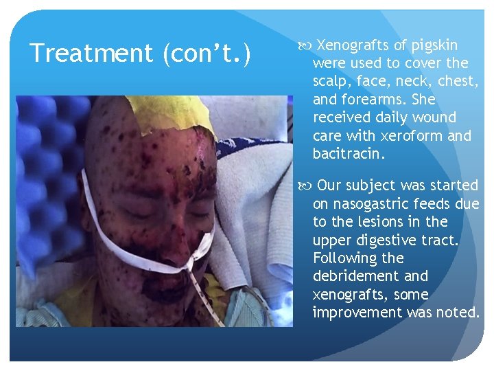 Treatment (con’t. ) Xenografts of pigskin were used to cover the scalp, face, neck,