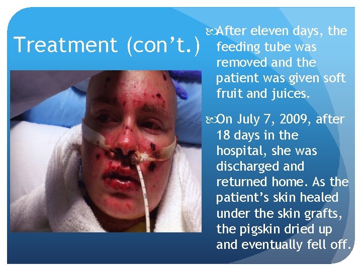 Treatment (con’t. ) After eleven days, the feeding tube was removed and the patient