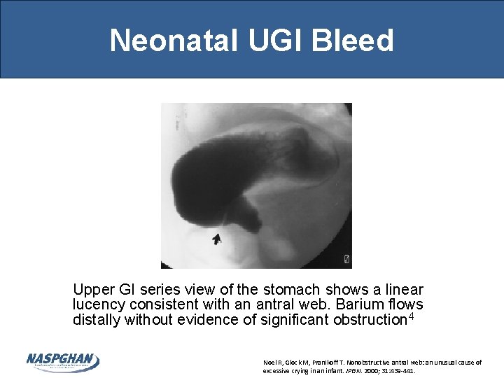 Neonatal UGI Bleed Upper GI series view of the stomach shows a linear lucency