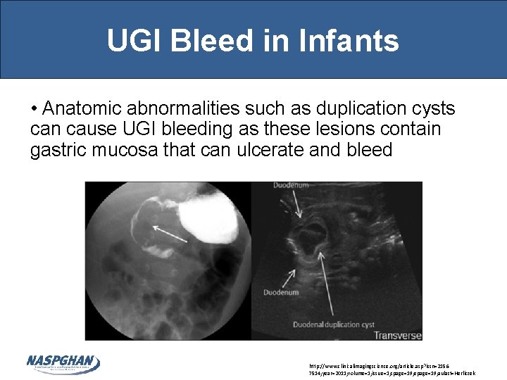 UGI Bleed in Infants • Anatomic abnormalities such as duplication cysts can cause UGI