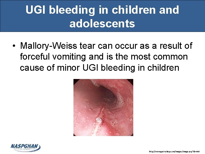 UGI bleeding in children and adolescents • Mallory-Weiss tear can occur as a result