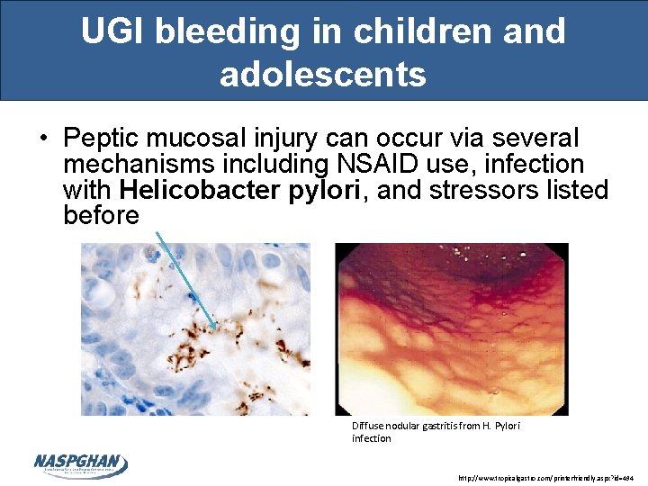 UGI bleeding in children and adolescents • Peptic mucosal injury can occur via several