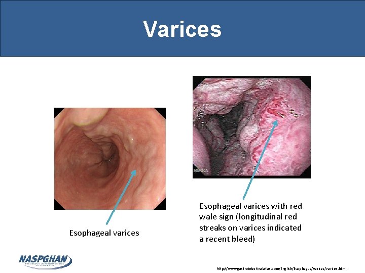 Varices Esophageal varices with red wale sign (longitudinal red streaks on varices indicated a