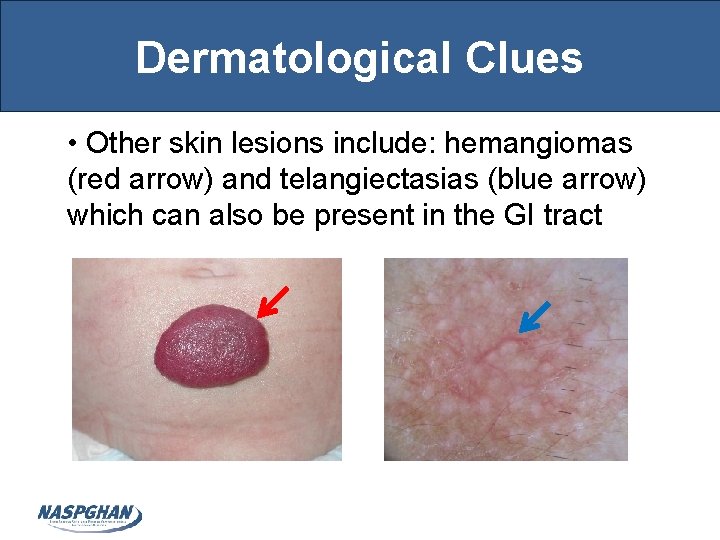 Dermatological Clues • Other skin lesions include: hemangiomas (red arrow) and telangiectasias (blue arrow)