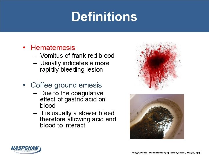 Definitions • Hematemesis – Vomitus of frank red blood – Usually indicates a more